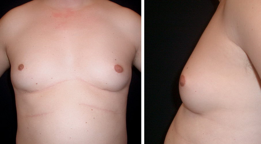 Risperdal causes abnormal male breast growth